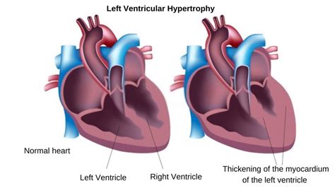 dilated lv means|left ventricular hypertrophy symptoms.